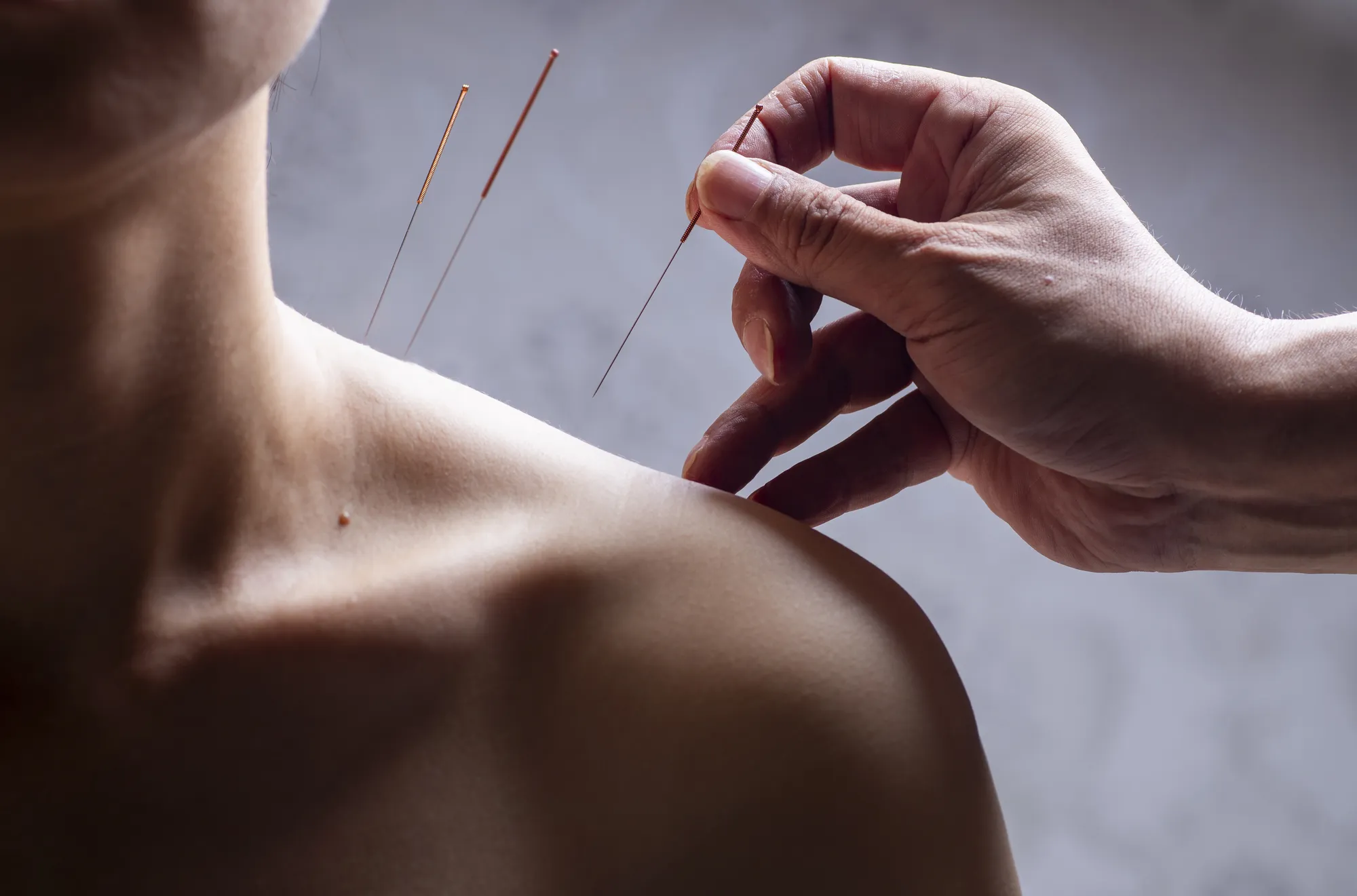 Close-up of a practitioner’s hand placing thin needles into a person's shoulder.